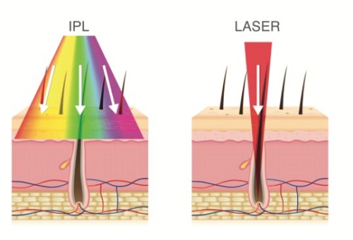 diferencia entre depilacin ipl y lser